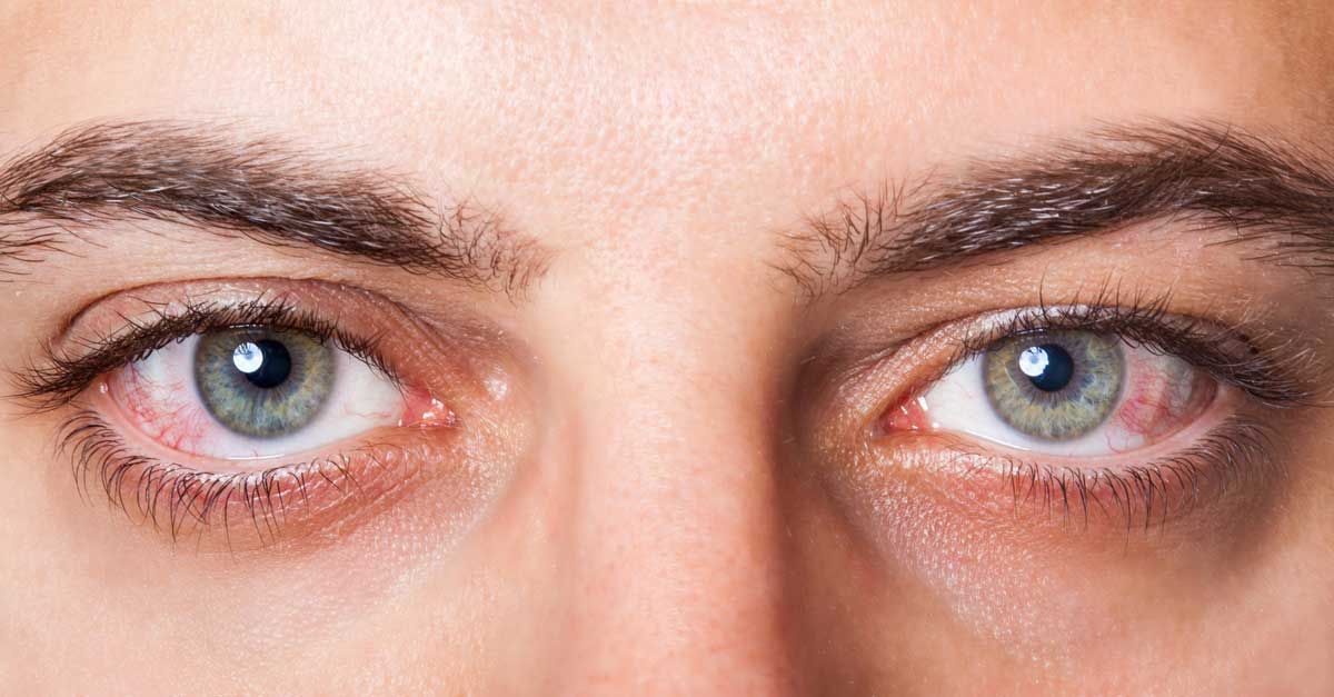 Occhi arrossati, irritati: non trascurarli. Per ogni causa c’è un rimedio- immagine 2