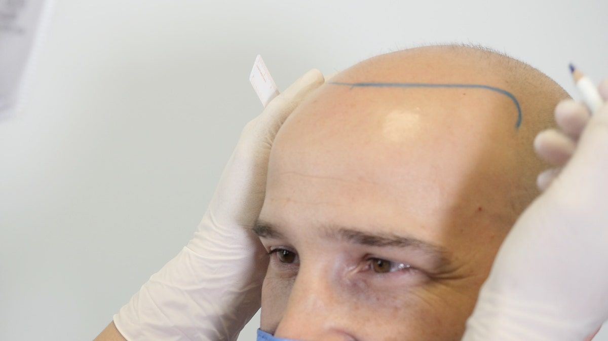 Alopecia androgenetica: scopri come si manifesta e corri ai ripari- immagine 4