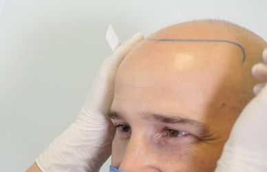 Il futuro del trapianto di capelli: veloce, high-tech e rassicurante