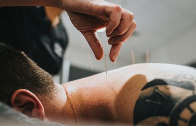 Agopuntura: sai perché può aiutare a stare bene?
