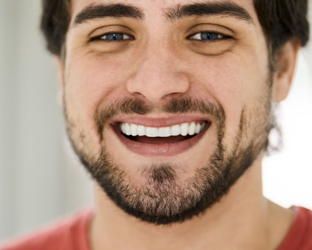 Sbiancamento dei denti: 5 domande all’igienista dentale