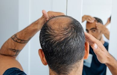 Caduta capelli: fino a che punto possono ricrescere? L’esperto risponde