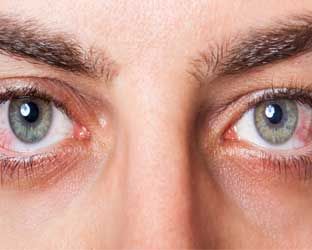 Occhi arrossati, irritati: non trascurarli. Per ogni causa c’è un rimedio
