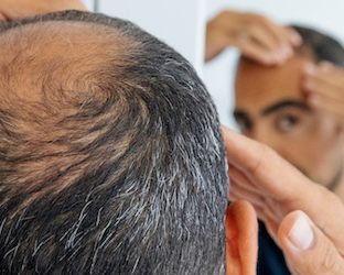 Caduta capelli: fino a che punto possono ricrescere? L’esperto risponde